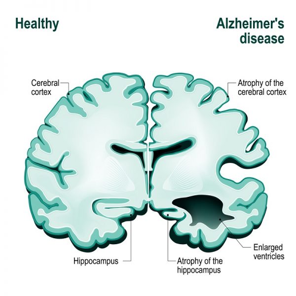 Cannabis and Alzheimers Disease – April-15- 2019 Rhea Graham